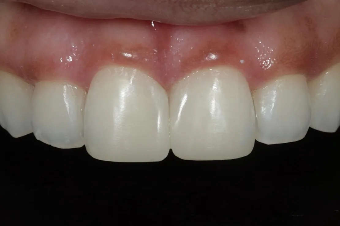 Replacing old composites — Composite bonding