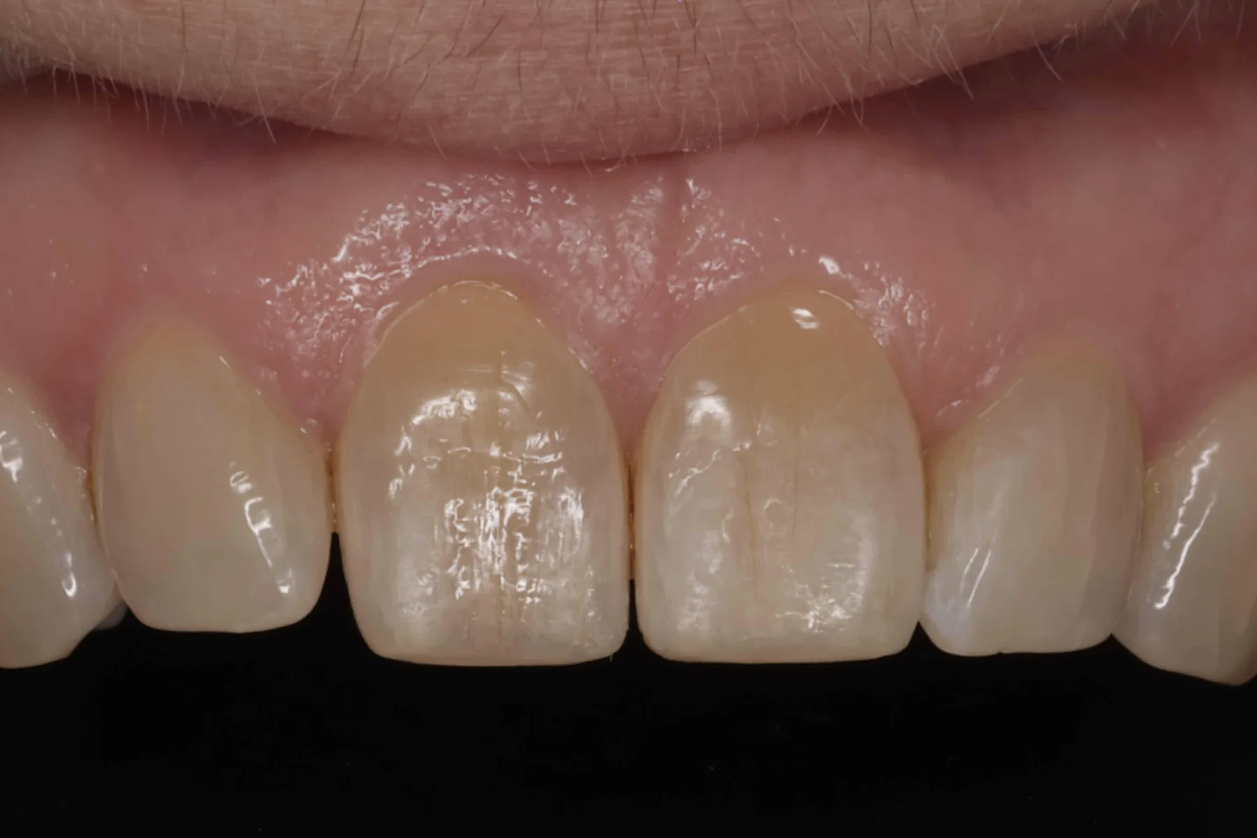 Refining worn edges — Edge bonding