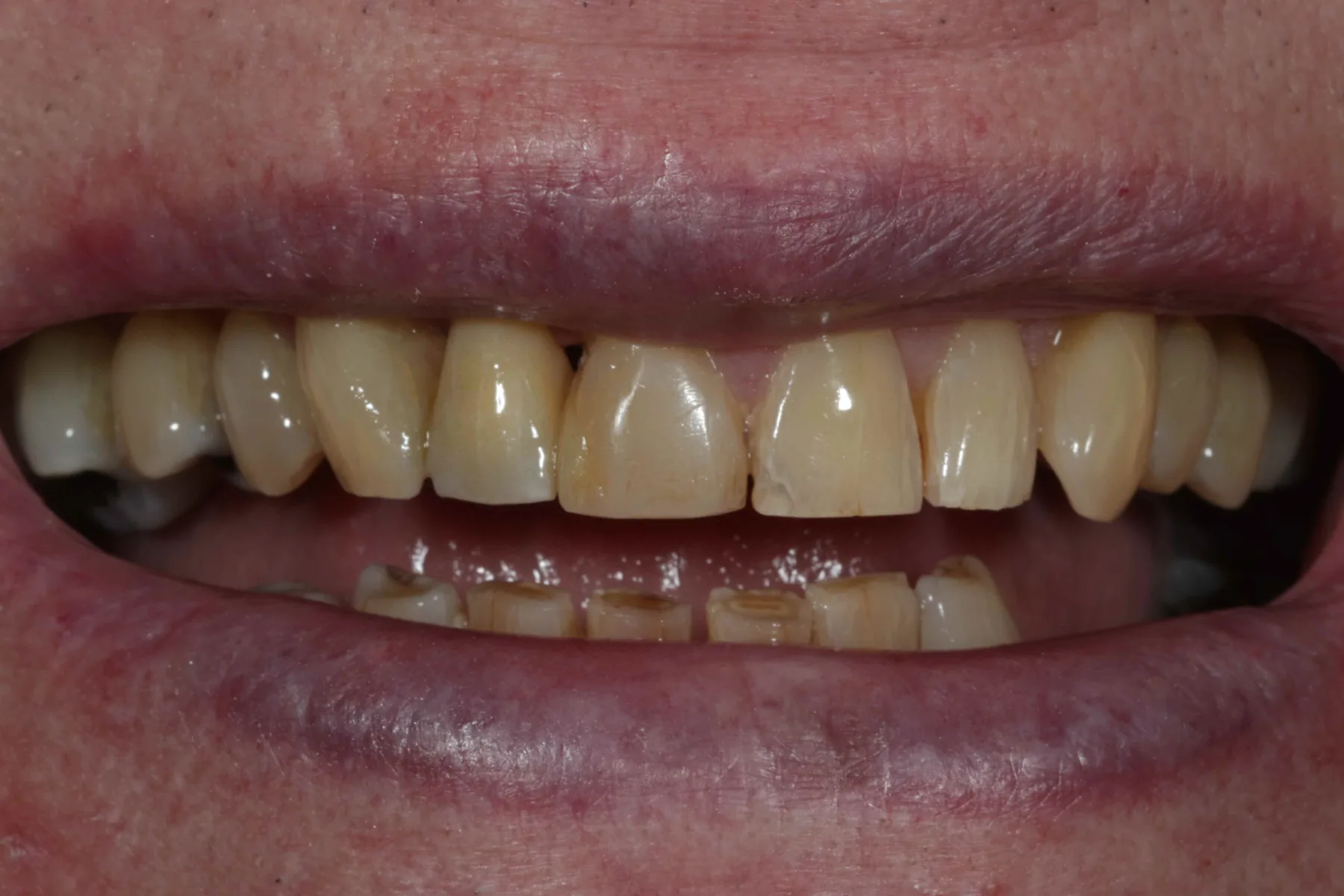 Bridging the gap, restoring the smile — Resin retained bridge