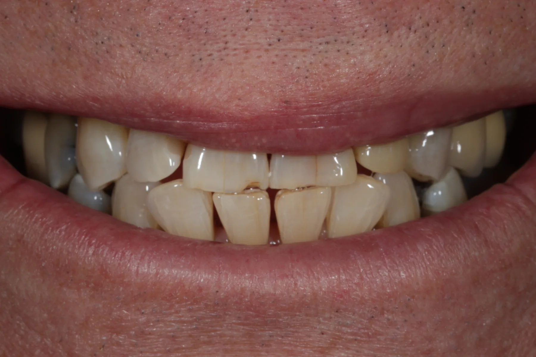 Simple yet effective bridge — Resin retained bridge