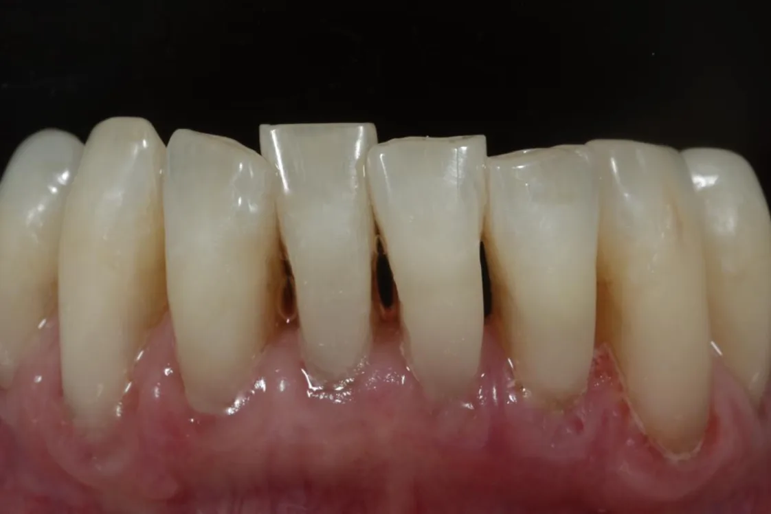 Facial composites — Worn surfaces restored