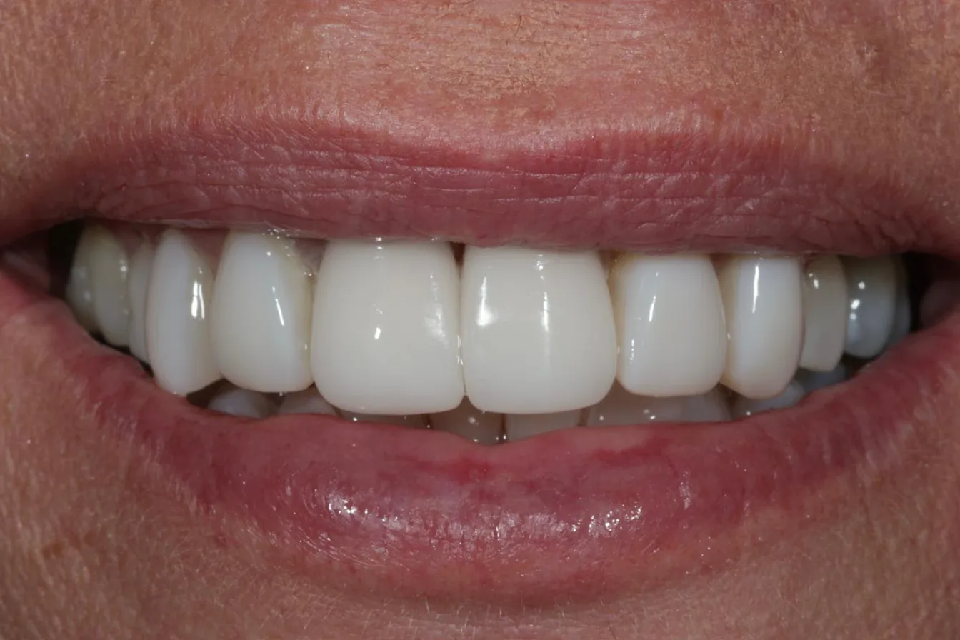 A full smile makeover — Veneers and crown replacements