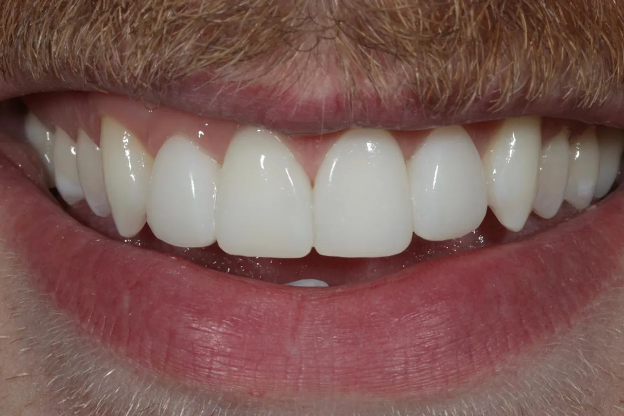 6 composite veneers — Pola whitening